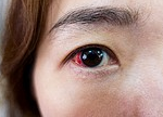 目の周りのかゆみはアレルギーから｜アトピー性皮膚炎になるきっかけ
